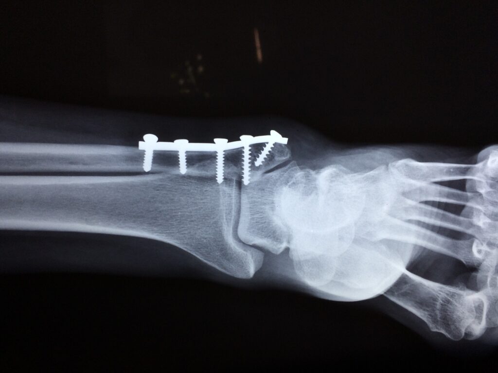 xray of a broken ankle